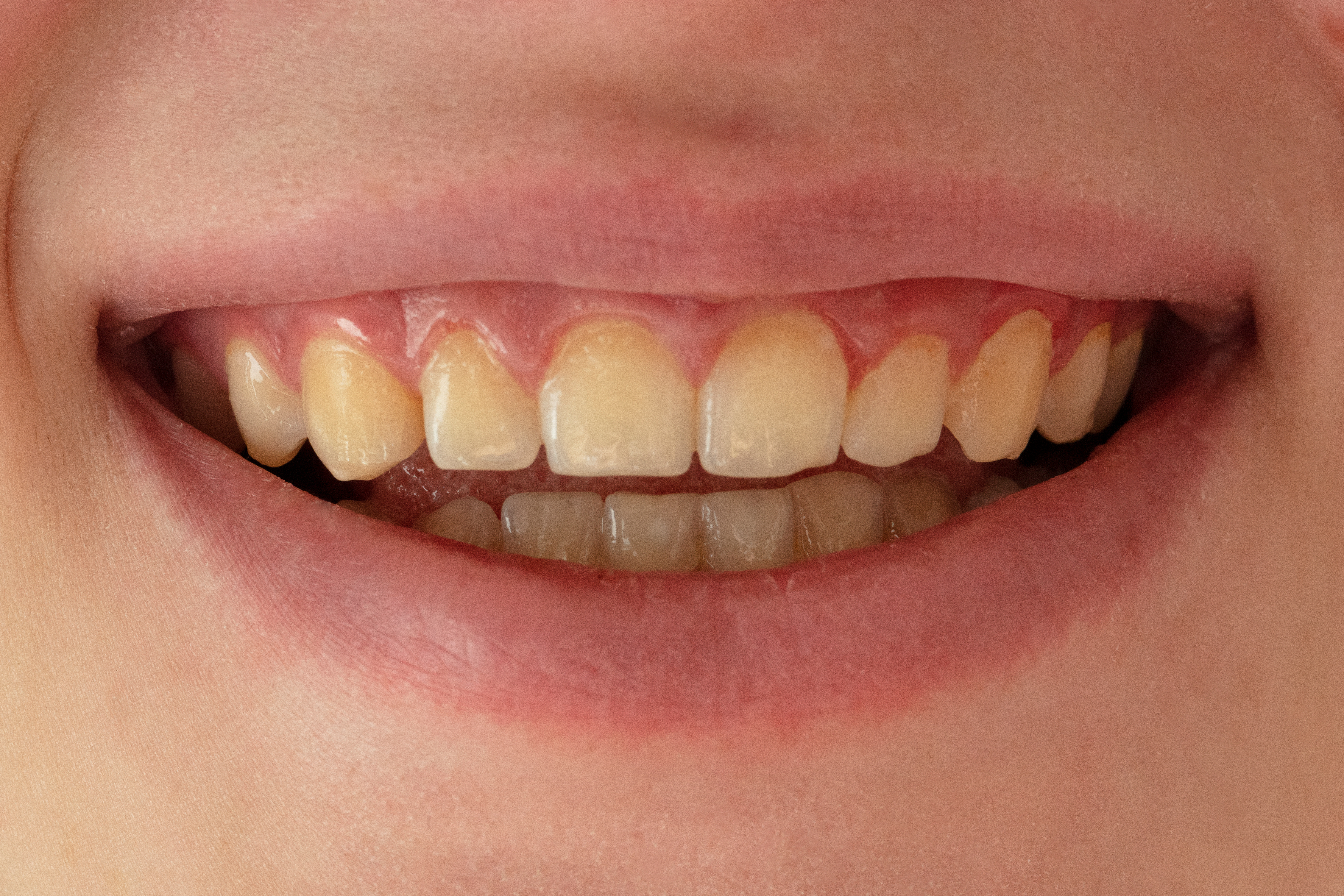 Dentes manchados e amarelados