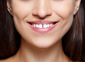Diastema - espaço entre os dentes