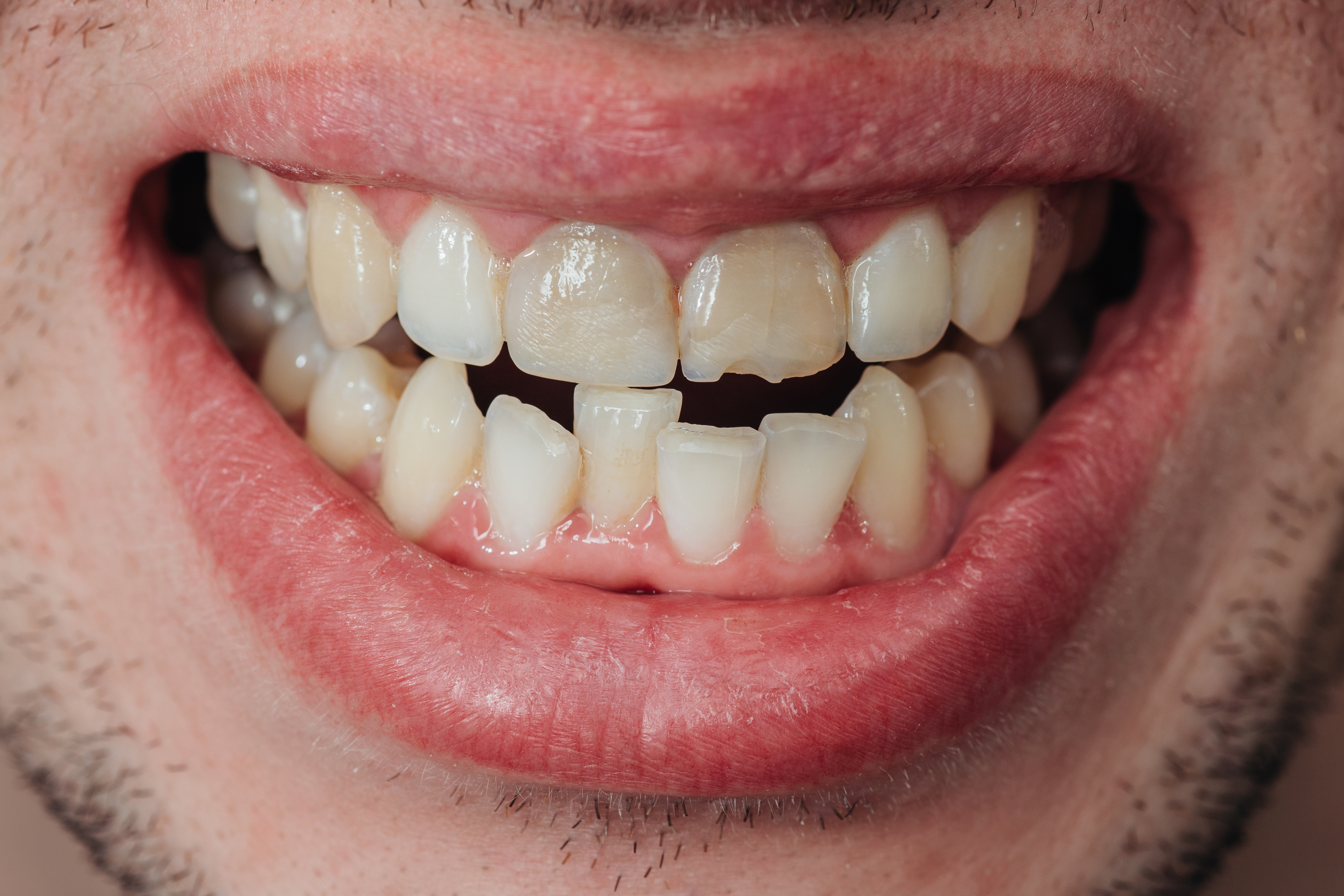 Dentes lascados e desalinhados