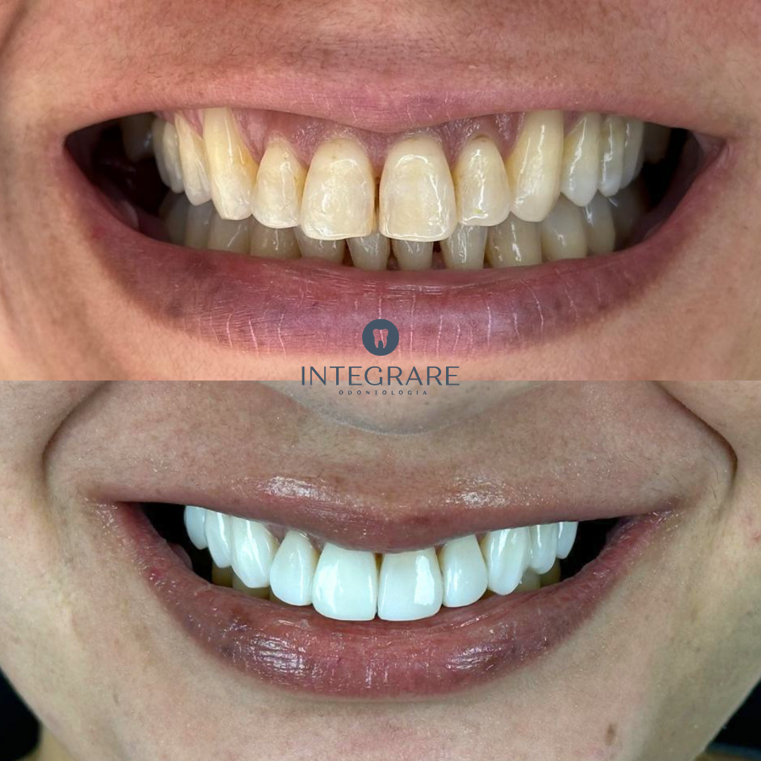 Antes e depois 1