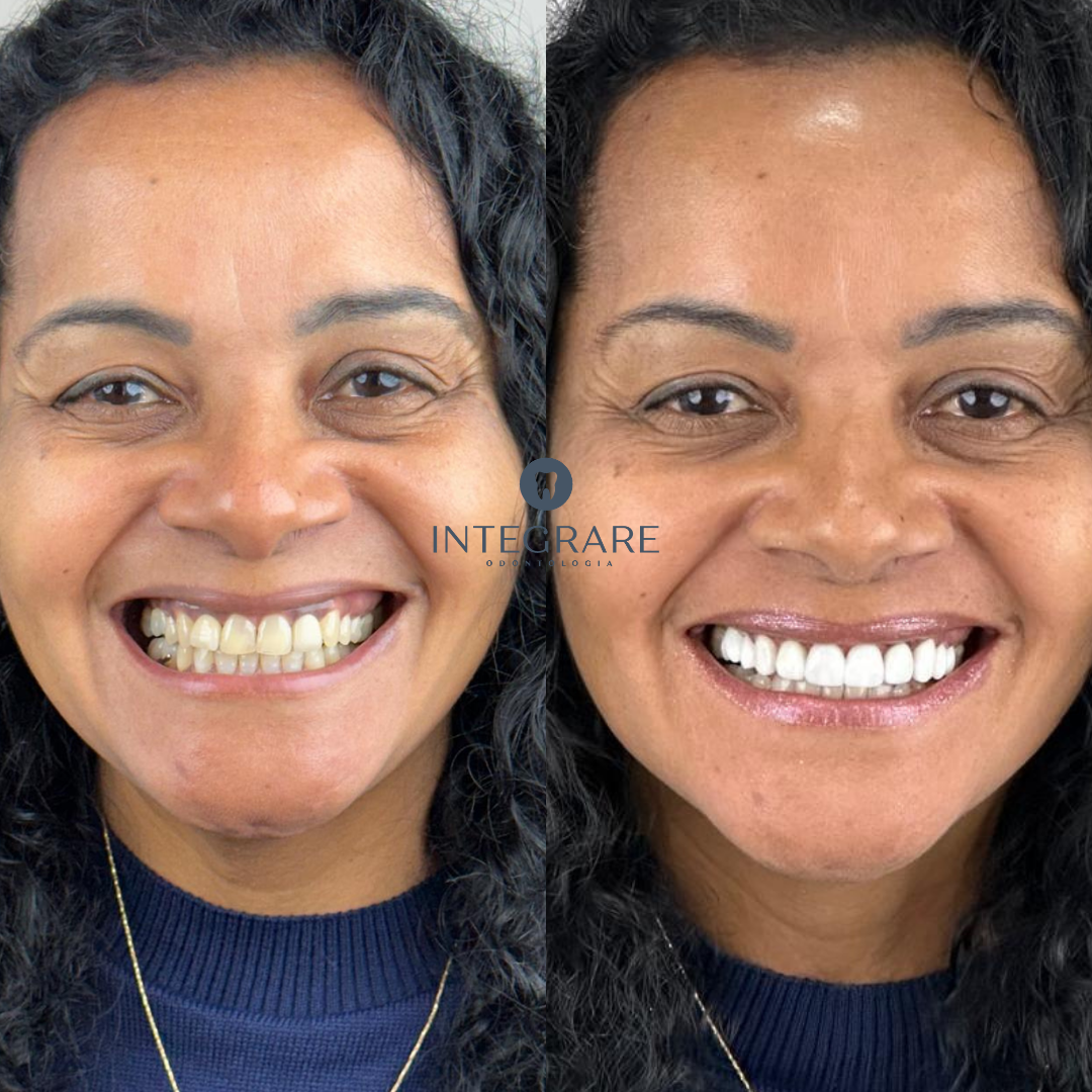 Antes e depois 2