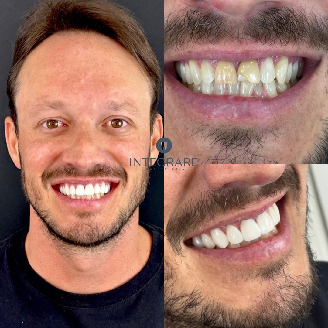 Antes e depois 3