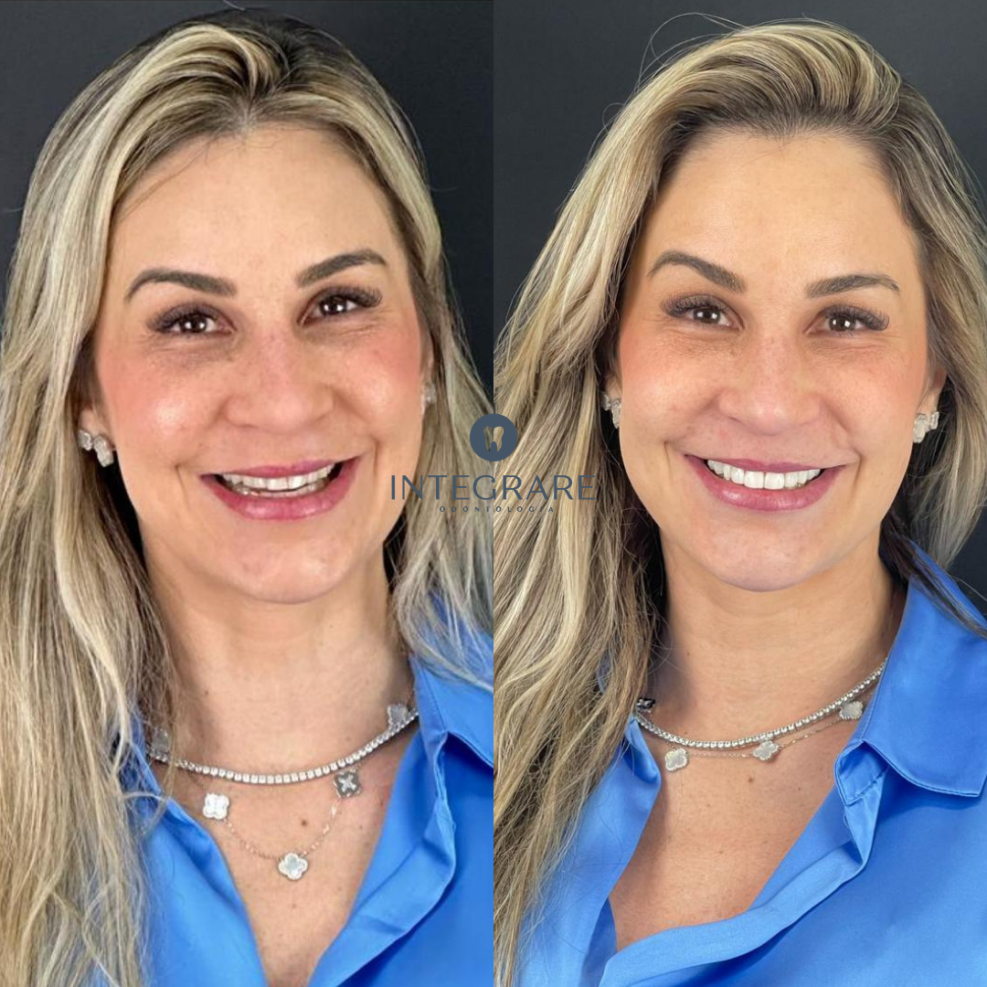Antes e depois 4