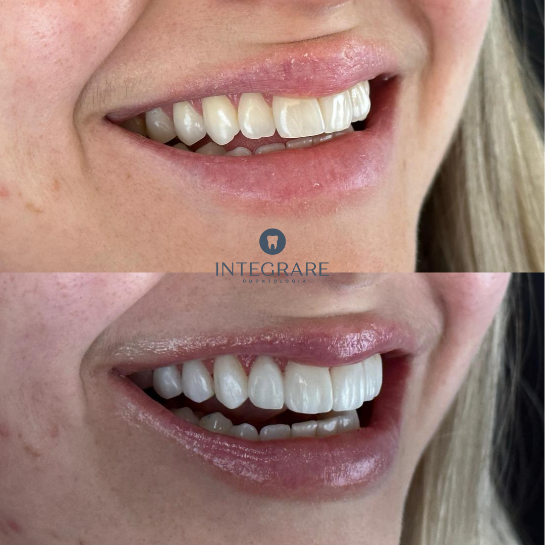 Antes e depois 5