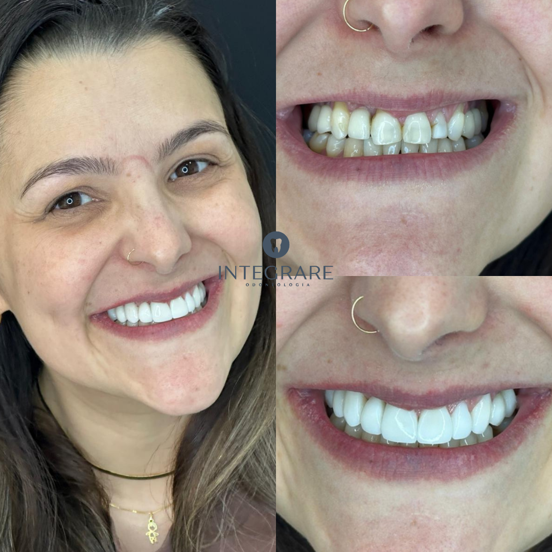 Antes e depois 6